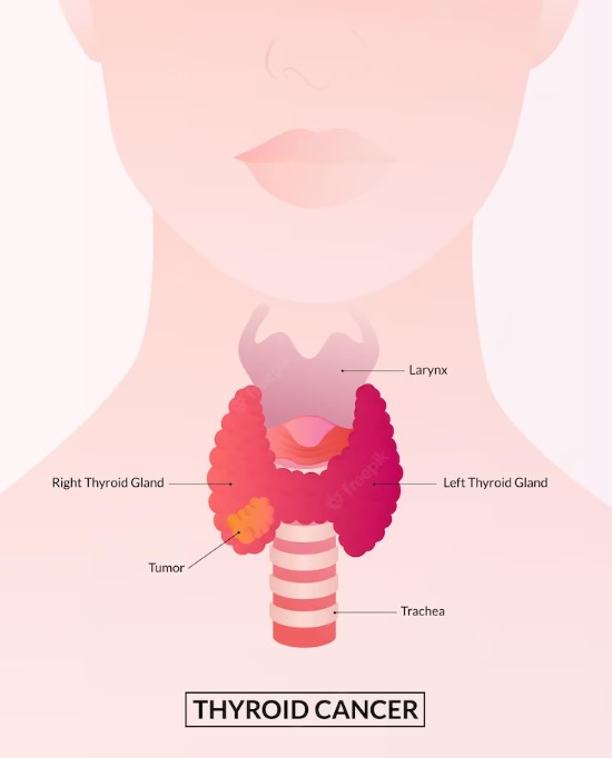 Thyroid cancer 